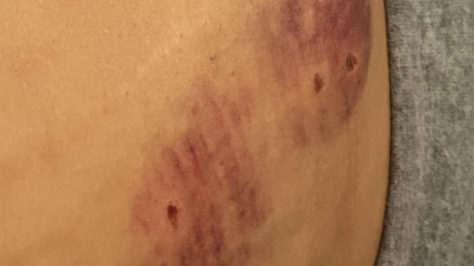 I got bit at work, should I report it or find an alternative?