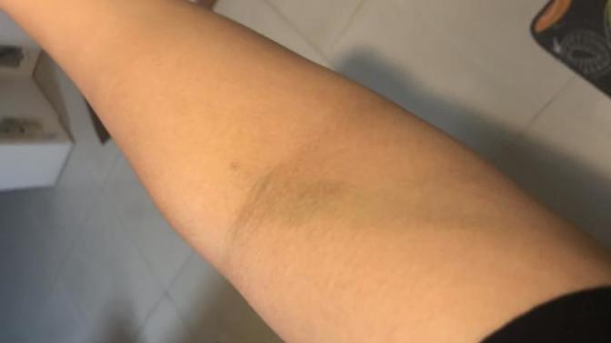 I donated my blood 4 days ago (1 Feb), is it normal to have bruises like this?