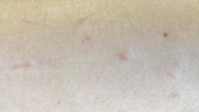 Any ideas on why random scratches are appearing on my arm?