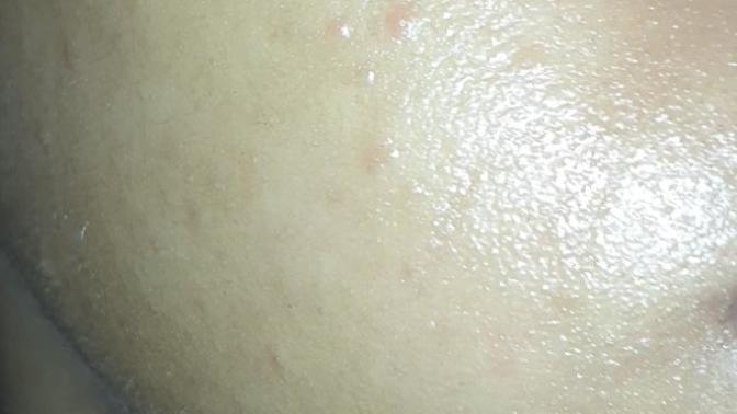 How can I stop feeling insecure about my pimples?