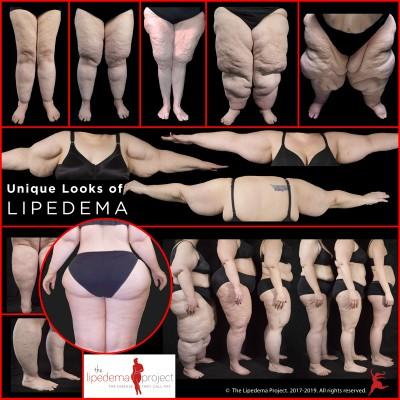Best way to lose/tone leg fat?