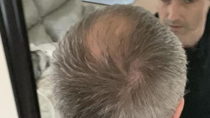 Which is best on me, bald spot and thinning hair or shaved (keep in mind the poll pic with hair has bald spot in back!)?