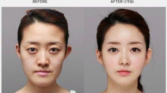Is cosmetic surgery worth it?
