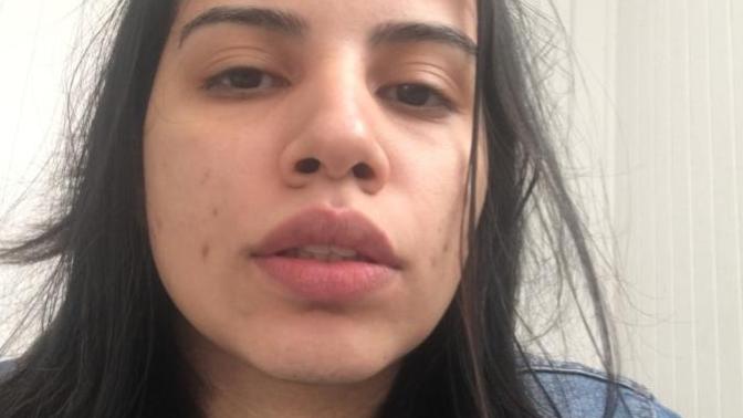 Girls, Help I don’t know what to do with my acne?