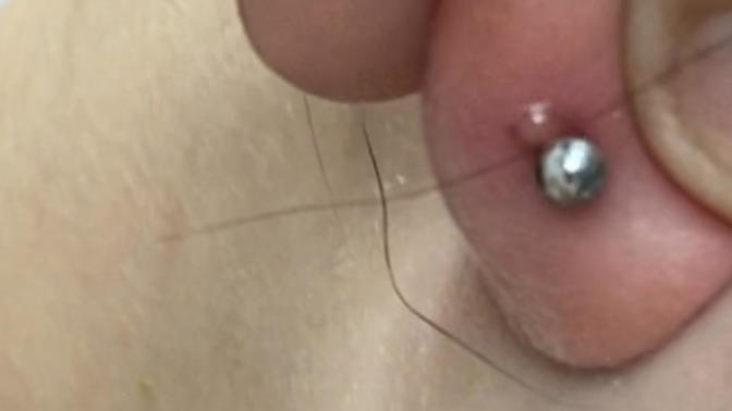 What is this on my lobe piercing?