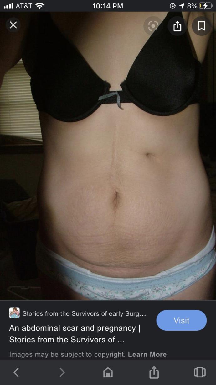 How should I handle my feeding tube scar?