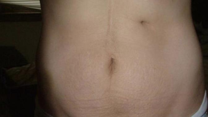 How should I handle my feeding tube scar?