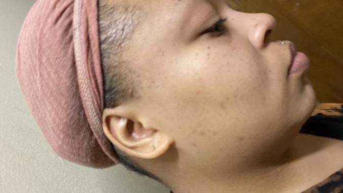 How can I get rid of acne?