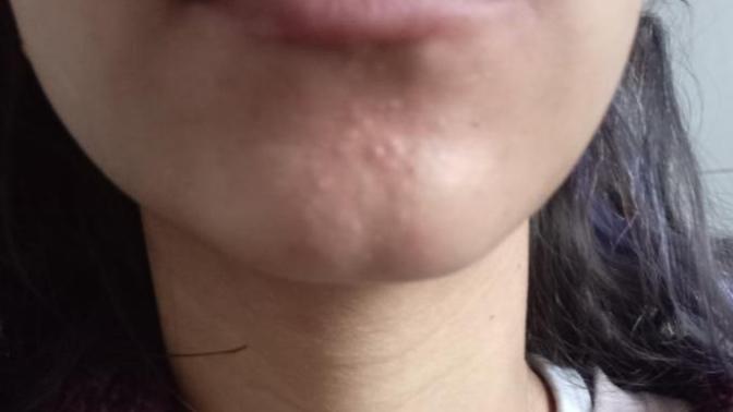How can I get rid of these weird acne scars?