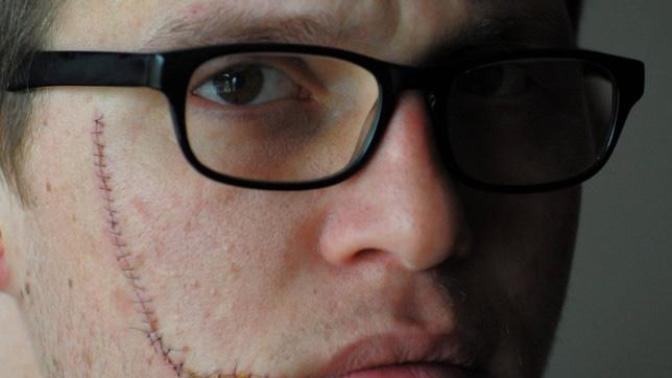 Do facial scars make men more attractive?