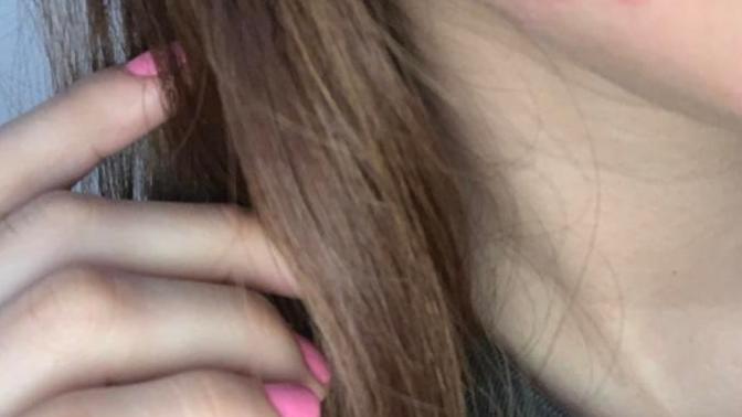 Are these pimples or blisters (picture)?