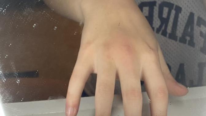 How do I know if my knuckle is broken?