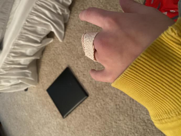 Part 2 of asking about broken knuckle?