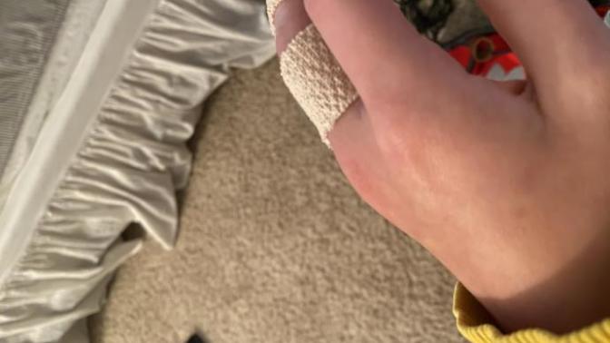 Part 2 of asking about broken knuckle?