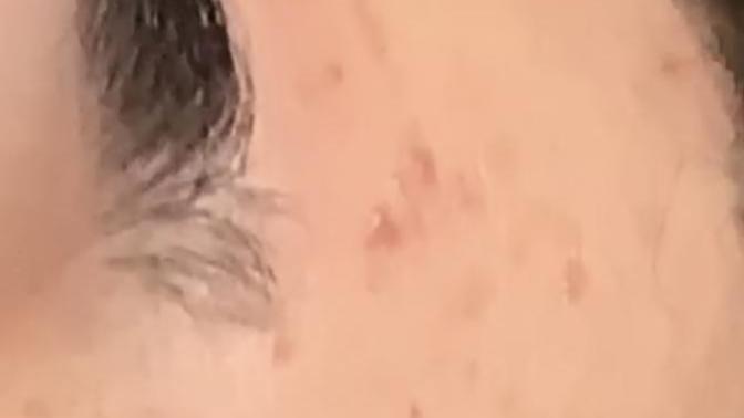 Can someone tell me what type of acne this is?