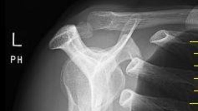 What is shown on xray?