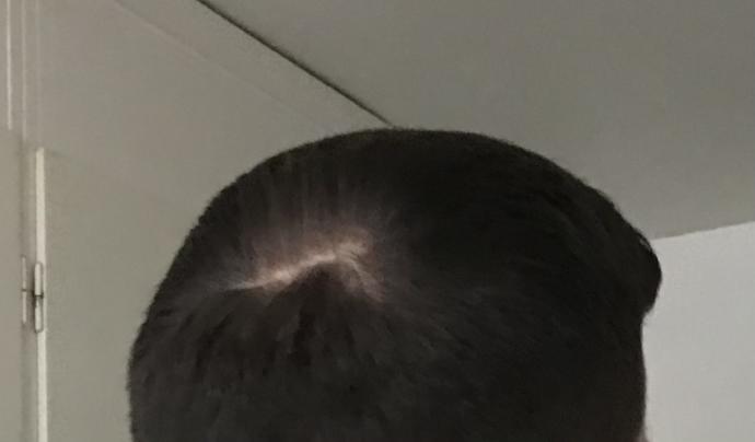 Is this a bald spot or a cowlick?