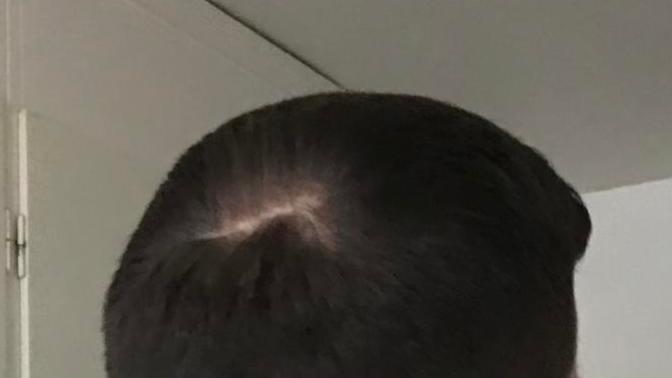 Is this a bald spot or a cowlick?