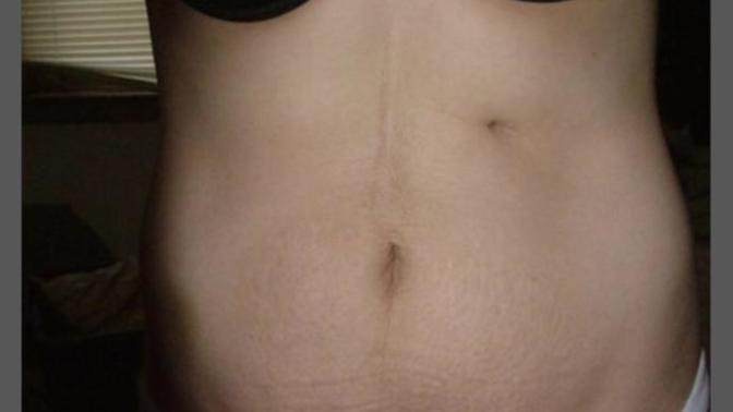 Would you be “put off” if a girl took off her shirt and you saw surgery scars?