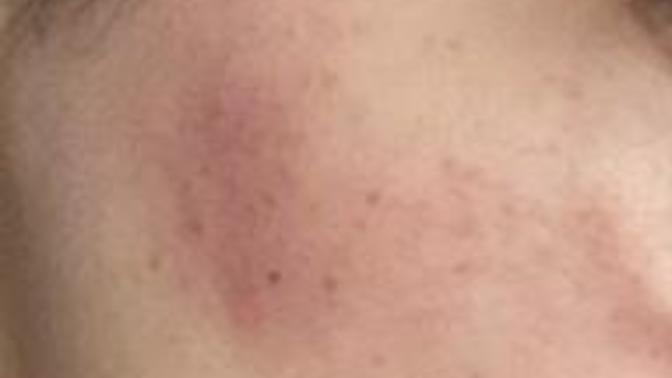 How to clear my skin?