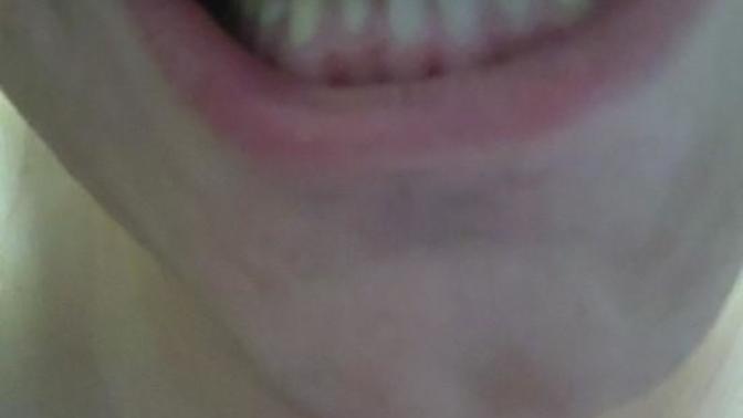 Best programs to straighten your teeth?