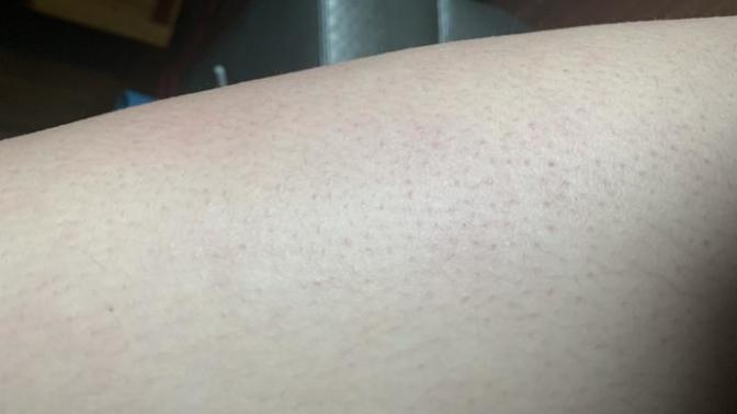 Does anyone know how to get rid of red bumps on my skin? or what they are? 😭?