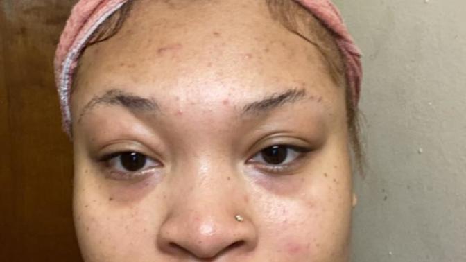 Are eyebags like this ugly or my acne?
