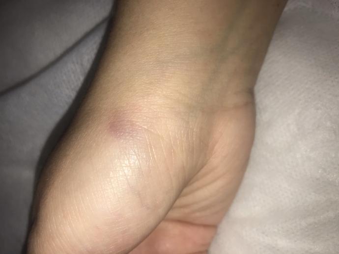 Little bruises appearing on my hand?