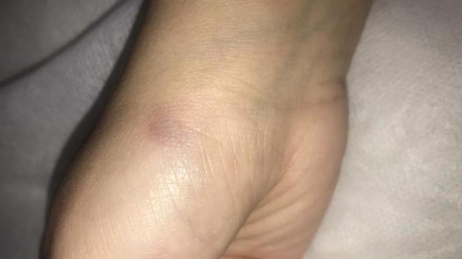 Little bruises appearing on my hand?