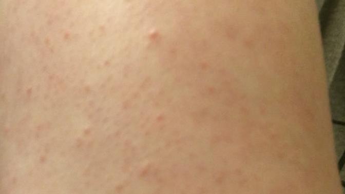 Guys, is it a turn off for a girl to have keratosis pilaris (chicken skin)?