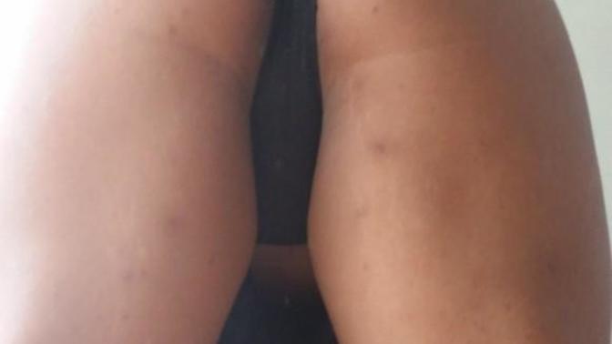 What are the weird little dark bumps you get on the back of the legs and butt?