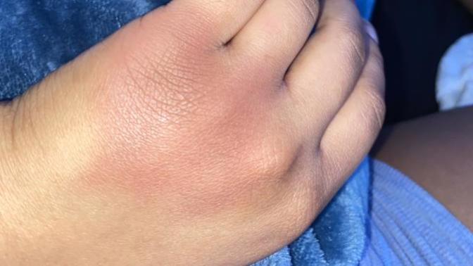 Fractured or bruised?