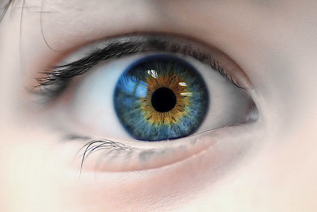 heterochromia