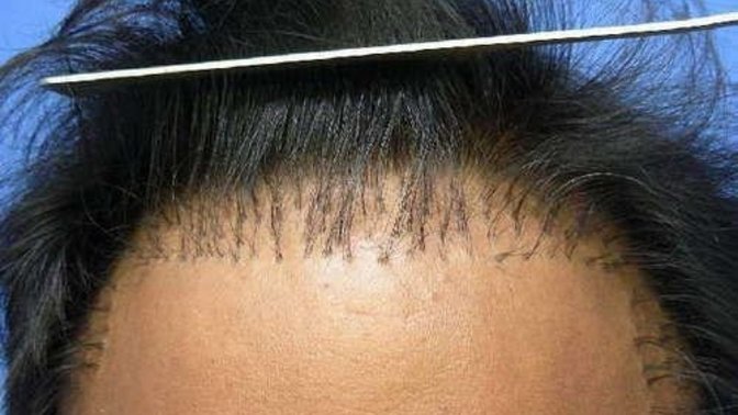 If you found out a guy got hair implants would you 🤮?