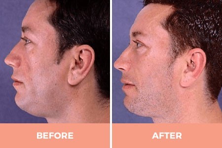 What do you think about face cheek implants?