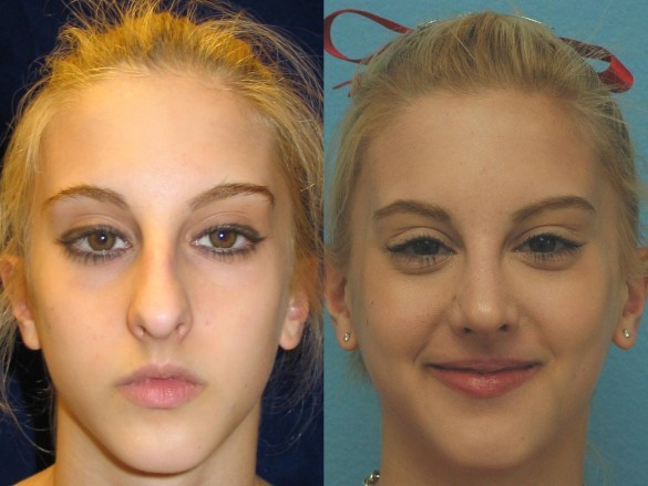What do you think about face cheek implants?