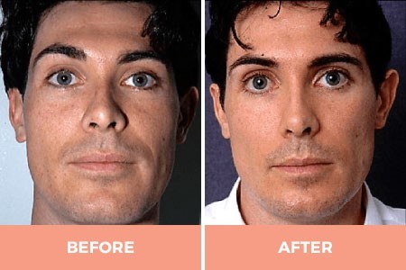 What do you think about face cheek implants?