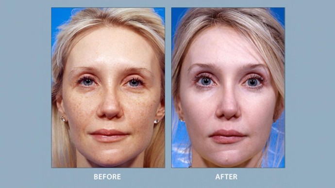 What do you think about face cheek implants?