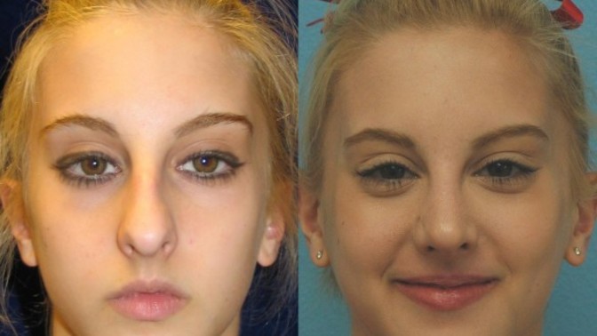 What do you think about face cheek implants?
