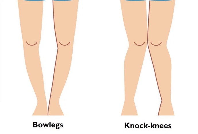 Are knock knees a dealbreaker?