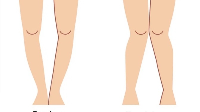 Are knock knees a dealbreaker?