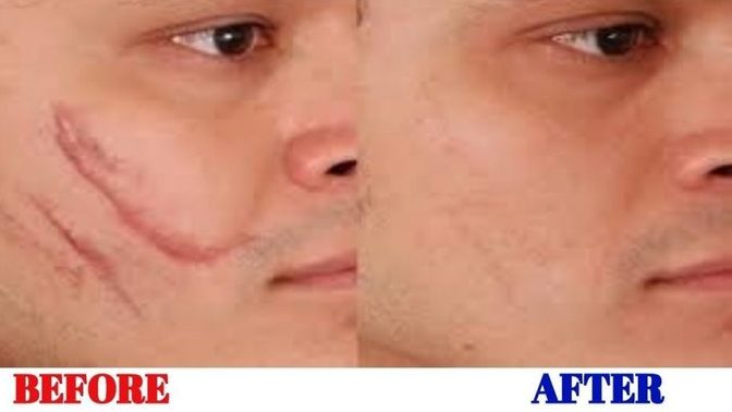 Thoughts on laser scar removal? Safe? Effective?