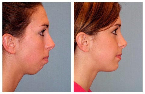 Whats the deal with jawbones?