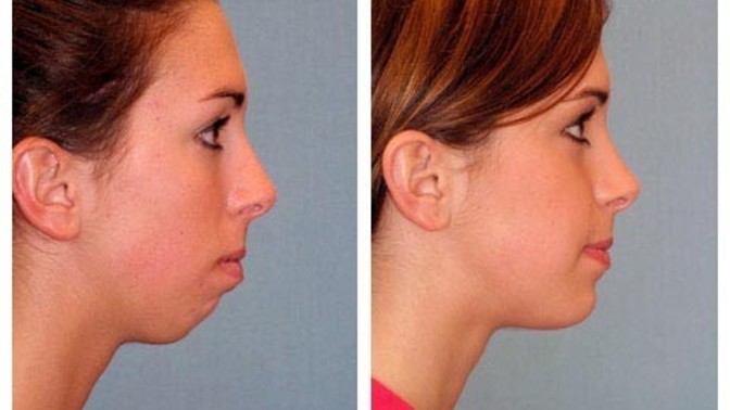 What's the deal with jawbones?