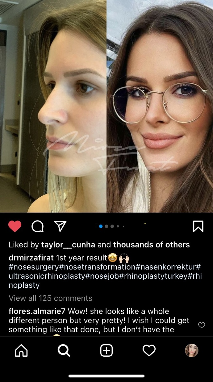 Should I get a nose job?