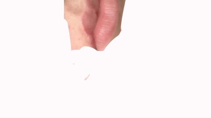 Can anyone tell my what this white bump is on my lip?