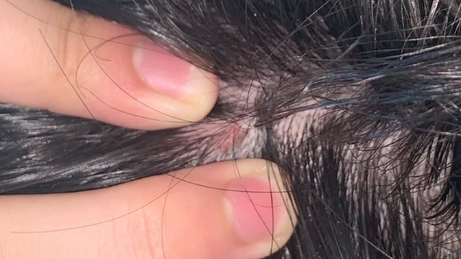 What is this spot on my scalp?