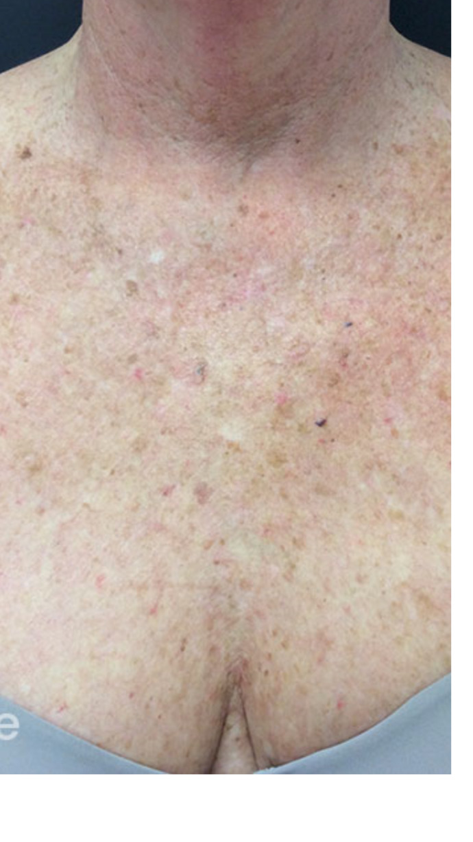 Sun damage to skin