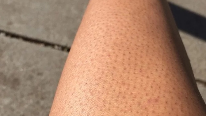 Do men find strawberry legs attractive?