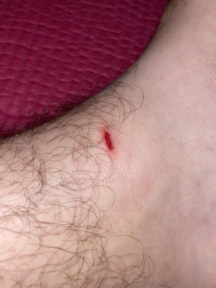 Will This Wound Leave a Scar?